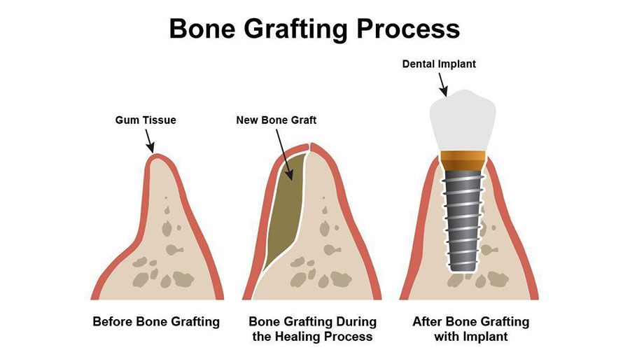 Bone grafting process