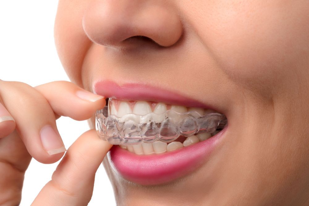 Woman placing Invisalign tray over her teeth