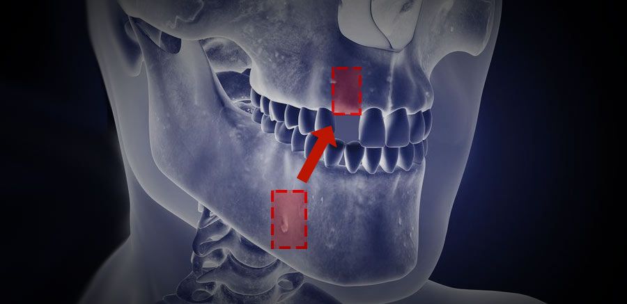 Dotted lines on jaw showing recipient and donor areas for bone grafting
