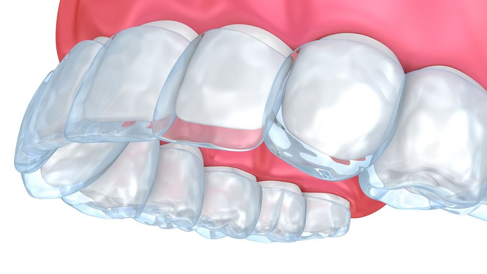 Illustration of Invisalign tray being fitted over top teeth