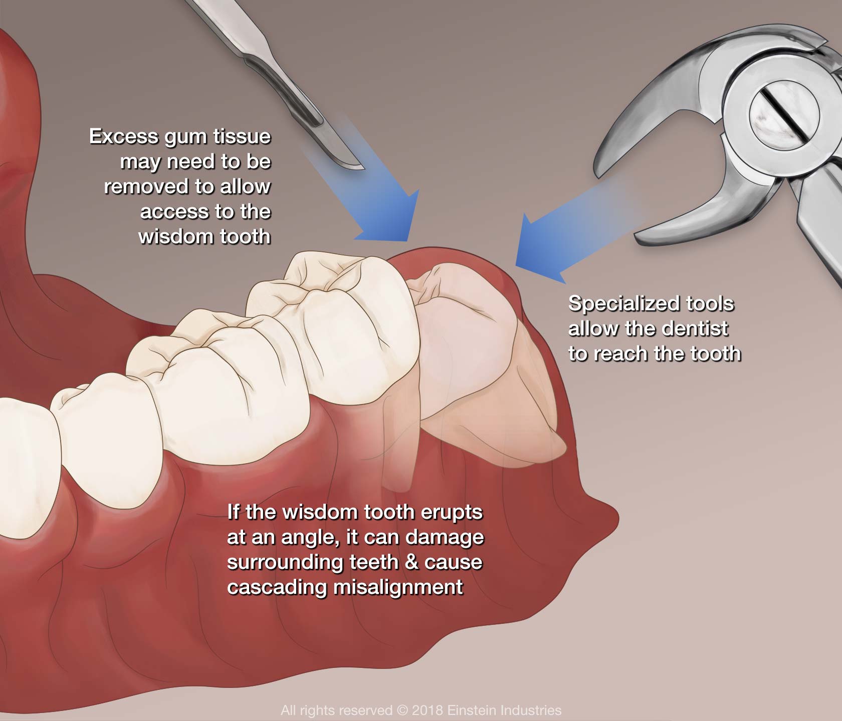 Illustration of wisdom tooth removal