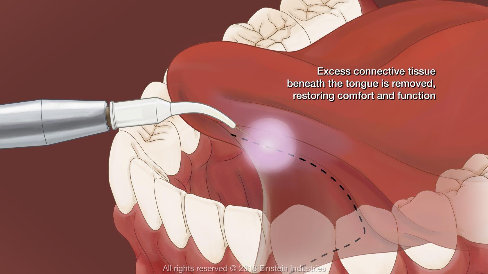 Illustration of frenectomy